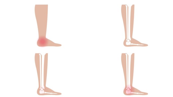 足踝关节疼痛矫形治疗动画