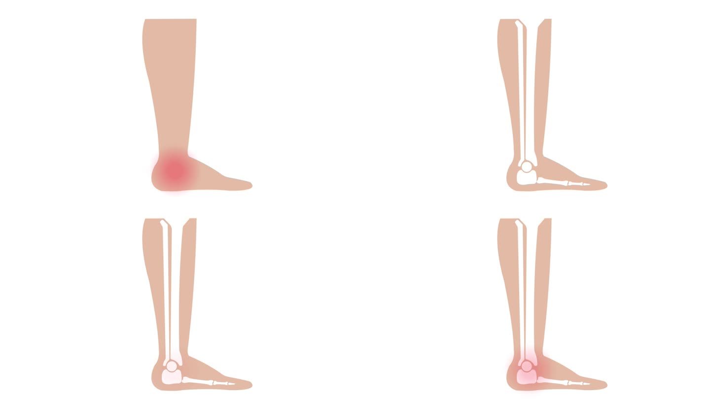 足踝关节疼痛矫形治疗动画