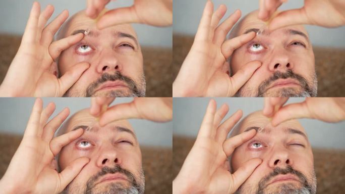 一名男子用眼药水治疗眼部症状。眼药水、眼科护理及医疗用药。疲劳的眼睛，刺激和过敏缓解