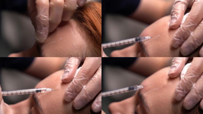 美容师在年轻美女的额头上注射肉毒杆菌。极致的近距离4k拍摄