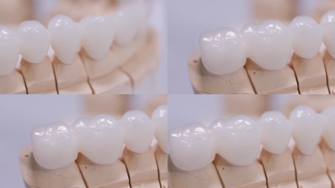 瓷牙与种植体在石膏模型隔离在白色背景上。