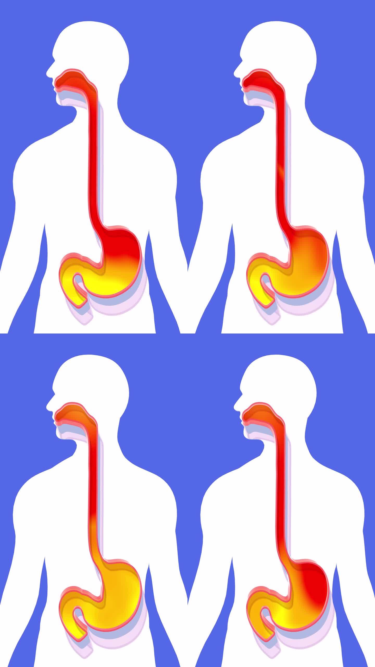 胃和食道的三维动画到嘴带火。