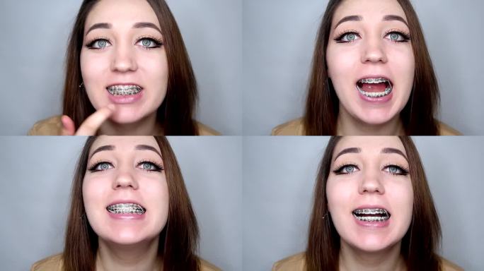 戴牙套的年轻女士张大嘴巴，显示矫正正畸弹性的张力。特写:戴牙套的妇女合上和打开牙齿，弹力对牙齿施加压