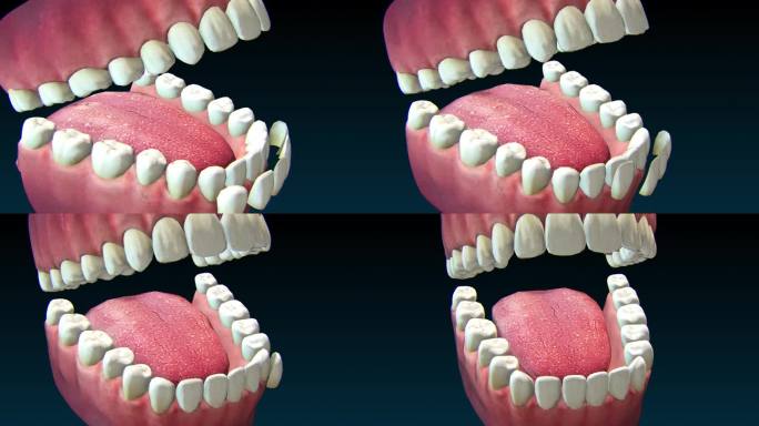 上颌犬齿种植体置换过程。