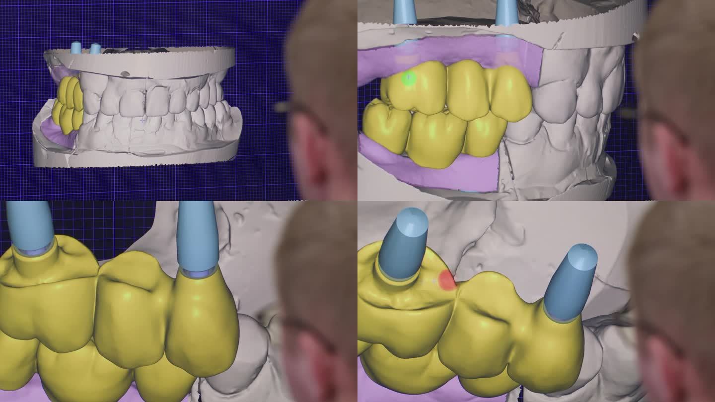 牙科技师用来修复牙齿的程序。