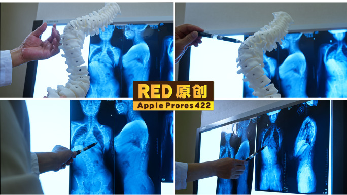 「RED拍摄」医脊柱侧弯CT影像医生看片
