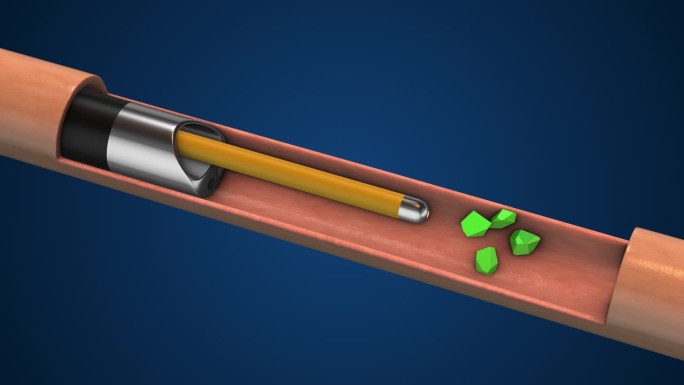 输尿管镜联合激光碎石治疗肾结石