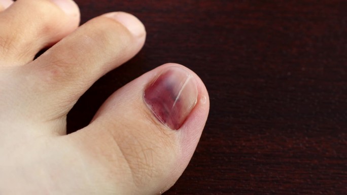 脚趾甲外伤后的脚趾或趾下血肿。不健康的大脚趾指甲下有瘀伤