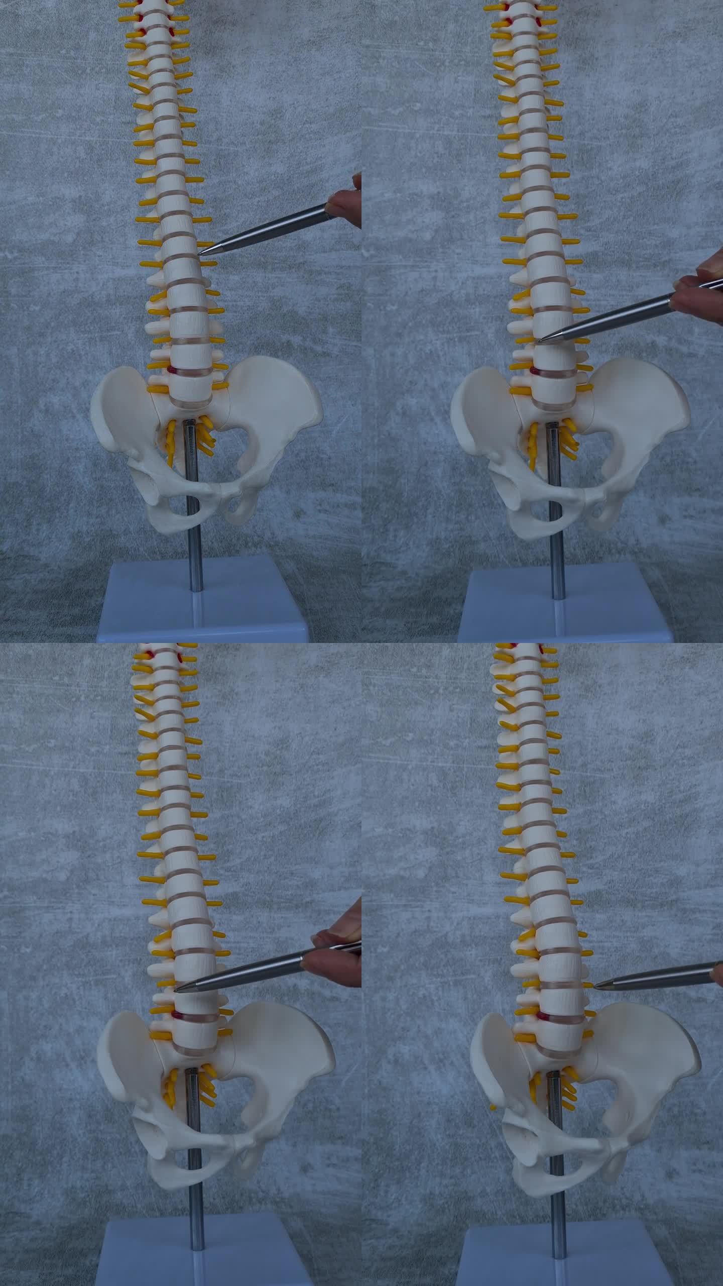 颈椎椎间疝及纤维环破裂