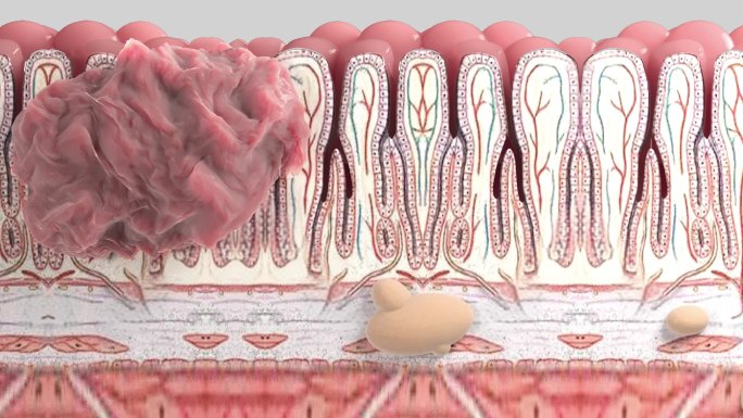 胃肿瘤腹膜腔种植转移动画