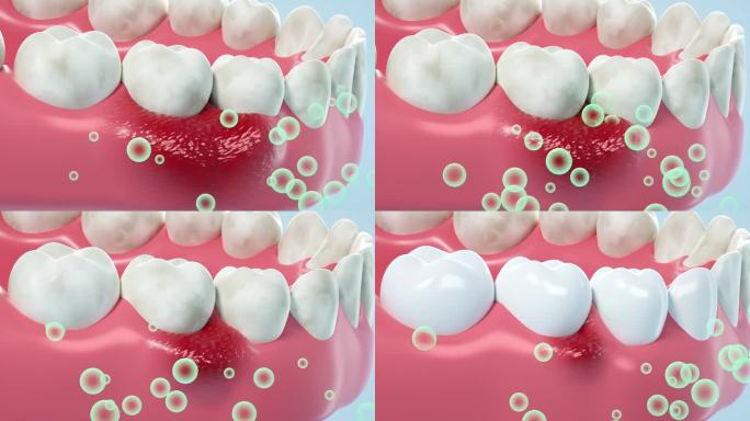 牙龈消肿修复 口腔牙齿去污清新口气