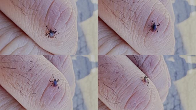 蜱虫在手上的皮肤上行走，随时会叮咬并传播疾病。一只森林蜱虫爬在一个人的胳膊上。宏。吸血昆虫对人体的特