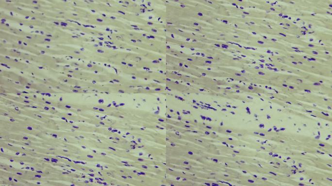 显微镜下人体心肌的组织学研究。放大400倍。心力衰竭和自然恶化