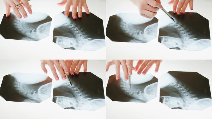 颈部x光特写。脊柱、头颅的磁共振成像。医生正在检查脊椎骨骼的x光片。医疗保健和医药概念。