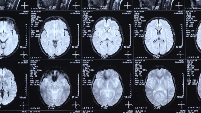 近距离观察MRI、MRI、CT对人脑的扫描图像。医疗理念。该疾病的诊断是人类头部。