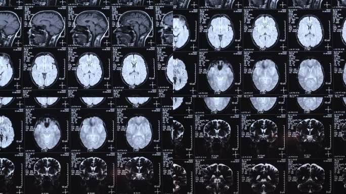 近距离观察MRI、MRI、CT对人脑的扫描图像。医疗理念。该疾病的诊断是人类头部。