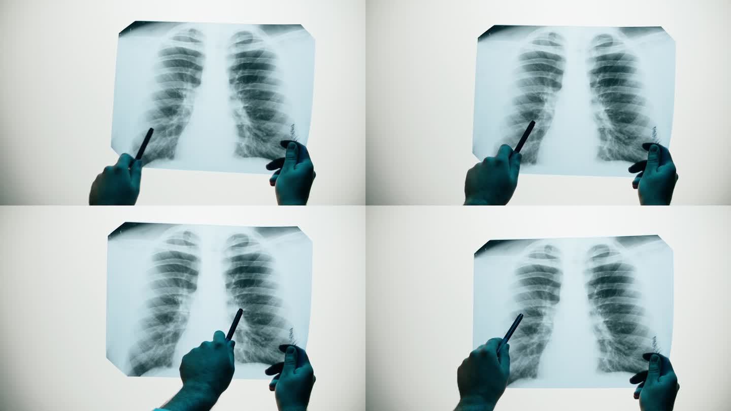 肺部x光特写。医生在看肋骨，人体胸部。保健医学理念，体检。