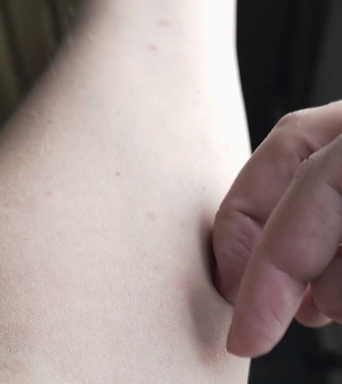 白人男性手臂内侧有搔抓、发痒、轻度过敏性皮疹