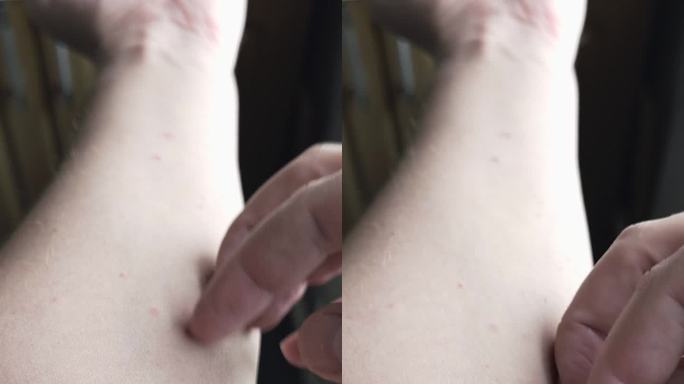 白人男性手臂内侧有搔抓、发痒、轻度过敏性皮疹