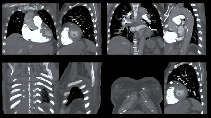 肺动脉CTA。
