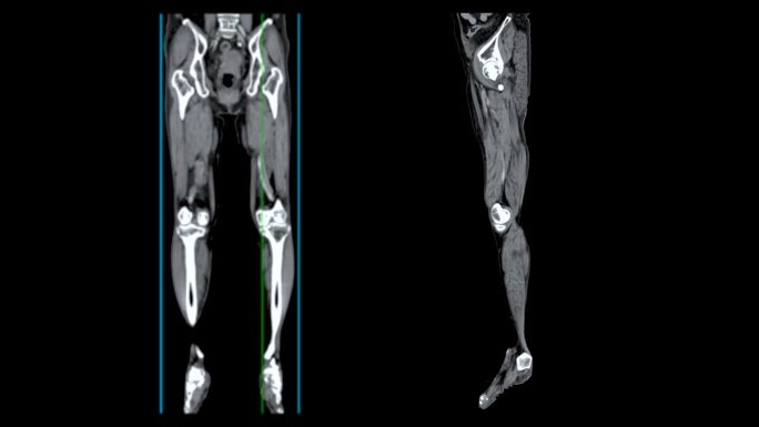 腿部的CT血管图。