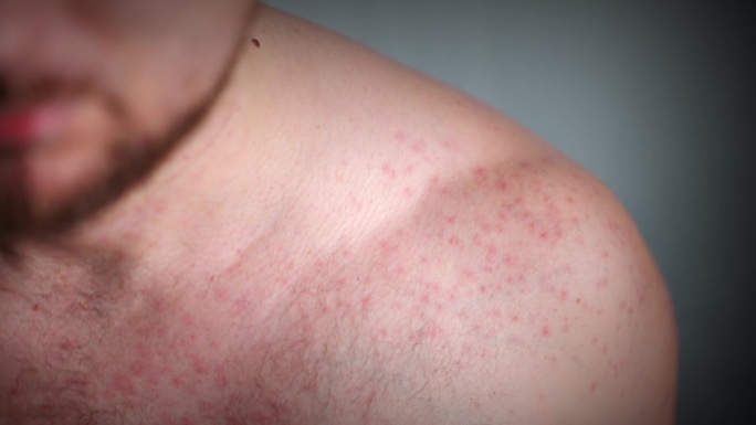 人体常见的皮肤问题，肩膀上的红斑是痤疮疹，不卫生的生活方式，脂肪食物，酒精，激素和压力导致皮疹和各种