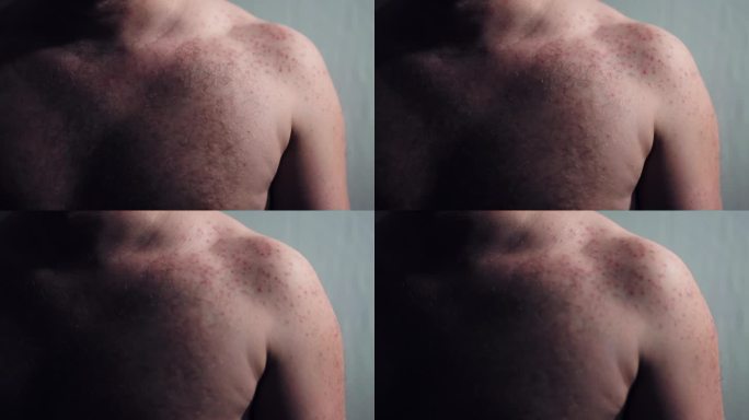 痤疮是油性皮肤的问题，男人肩膀上的红斑，由于不卫生的生活方式，脂肪食物，酒精，激素变化和压力引起的过