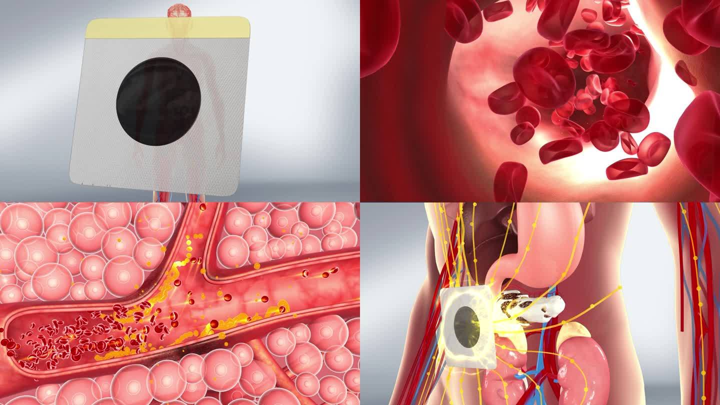 动脉硬化 血脂堆积 溶栓 血脂 血压