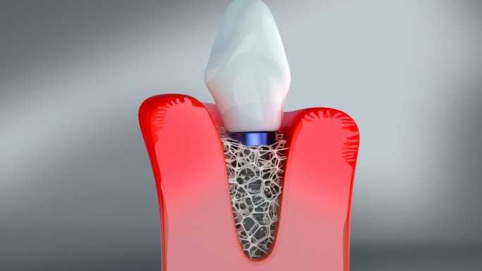 种植牙 镶牙 牙龈修复 牙龈肿痛