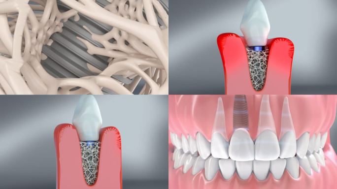 种植牙 镶牙 牙龈修复 牙龈肿痛