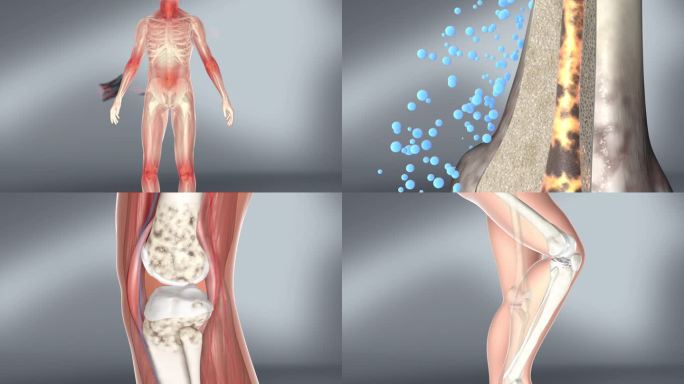 风湿 关节炎 骨关节 风寒湿邪