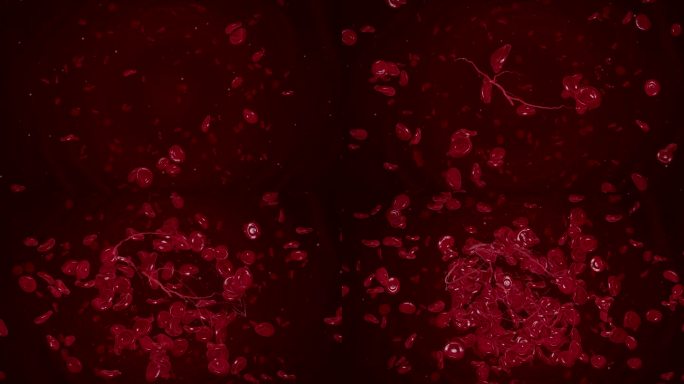 红细胞汇聚形成血栓血块血管堵塞