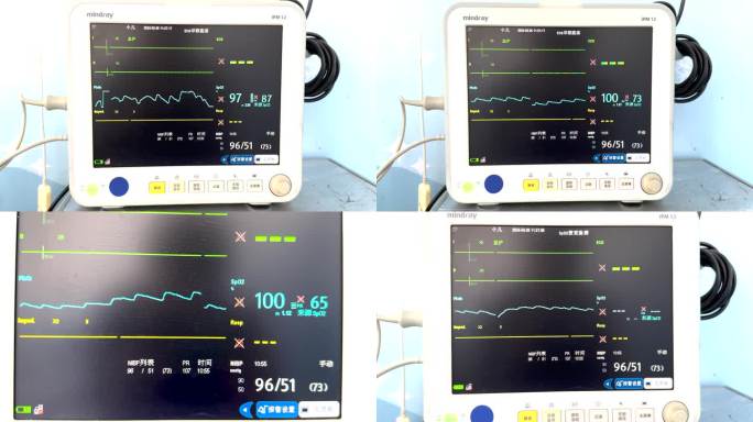 监护仪器心电图波形图