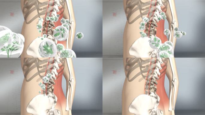 修复骨骼 腰间盘突出 骨质增生 腰突