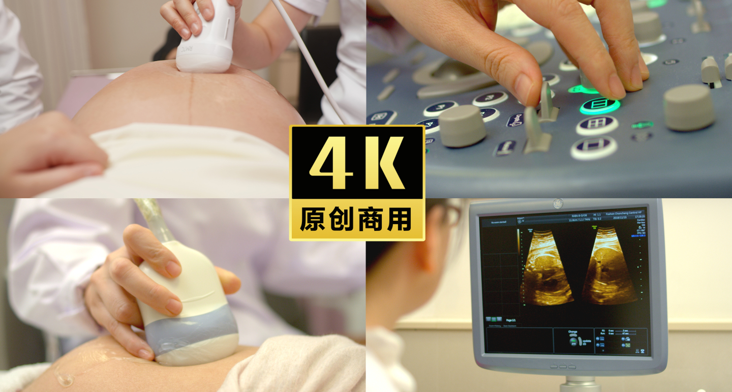 医院孕妇检查超声波B超影像