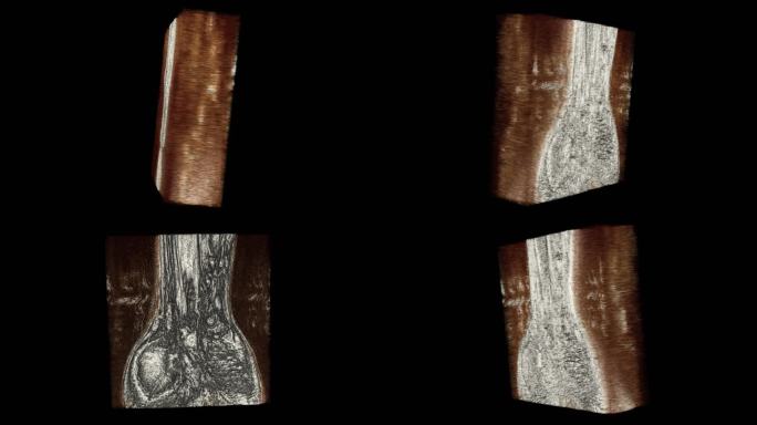 腕部核磁 手腕MRI影像 三维切片 1