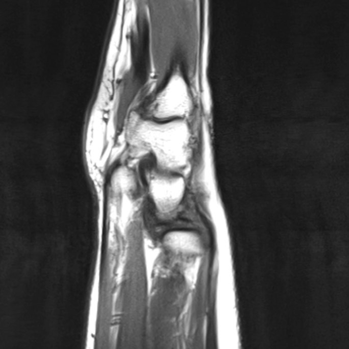 腕部核磁 手腕MRI影像 黑白影像 9