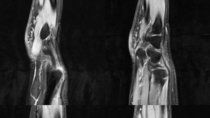 腕部核磁 手腕MRI影像 黑白影像 11