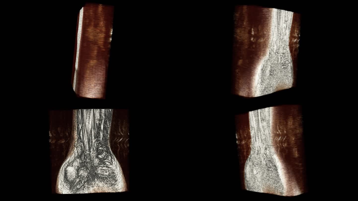 腕部核磁 手腕MRI影像 三维切片 3