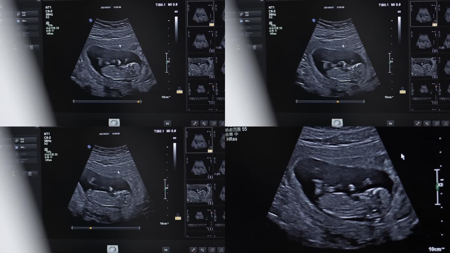 孕妇B超胎儿