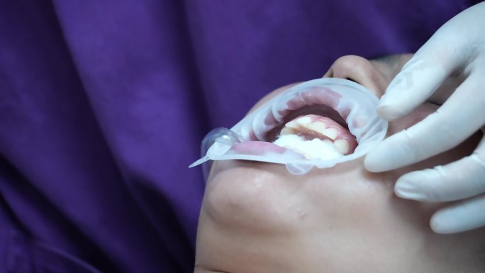 4K微创瓷贴面牙齿修复操作实拍