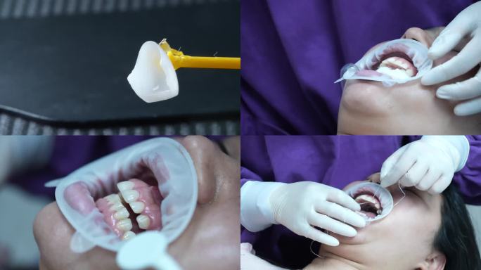 4K微创瓷贴面牙齿修复操作实拍