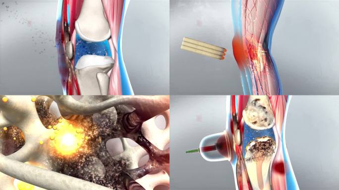 关节炎 软骨软组织 腿关节  艾灸 热疗