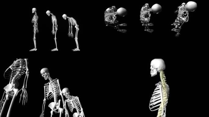 骨质疏松驼背骨骼对比动画