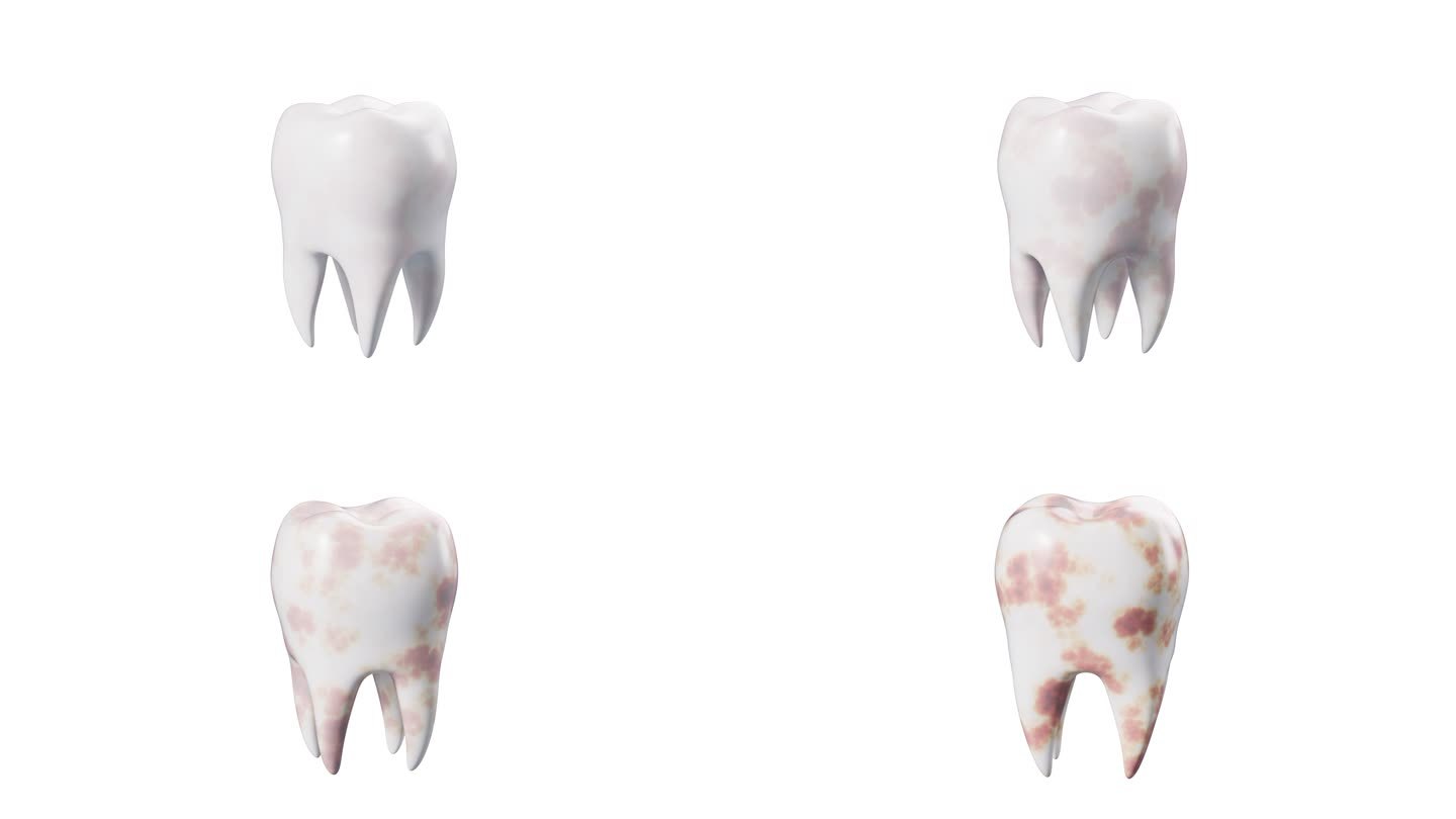 带透明通道的牙齿牙菌斑牙结石牙垢视频