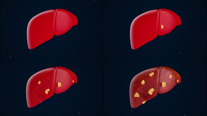 脂肪肝三维动画