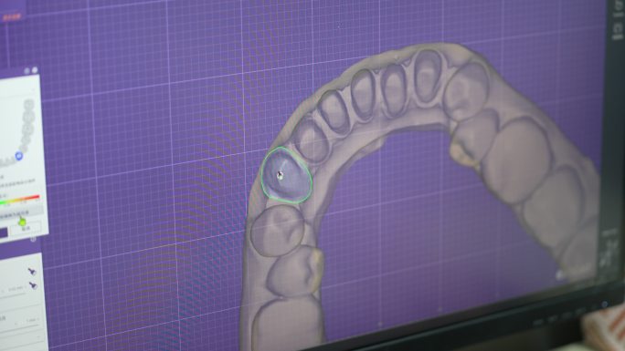 牙齿牙医修牙义齿打磨牙齿假牙视频