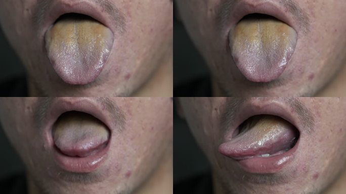舌苔发黄