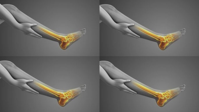 腿骨疼痛医学动画