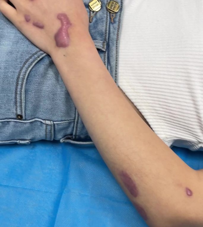 女性手部疤痕疙瘩疤痕修复 仪器治疗-竖屏